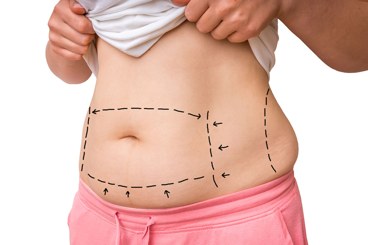 Plastic surgery doctor draw lines with marker on patient belly - isolated on white background